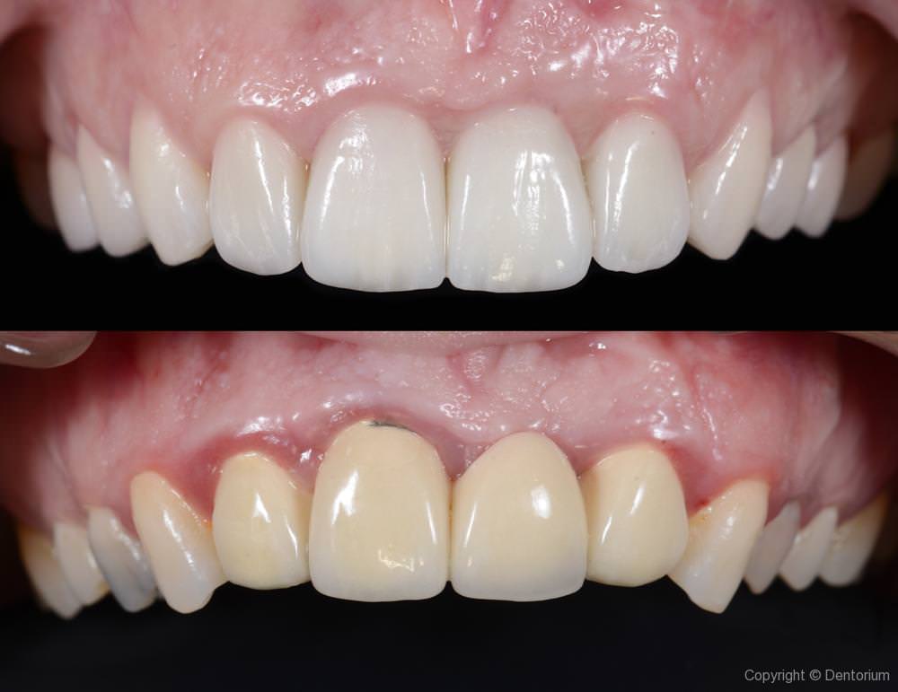 Intraoral view BEFORE & AFTER