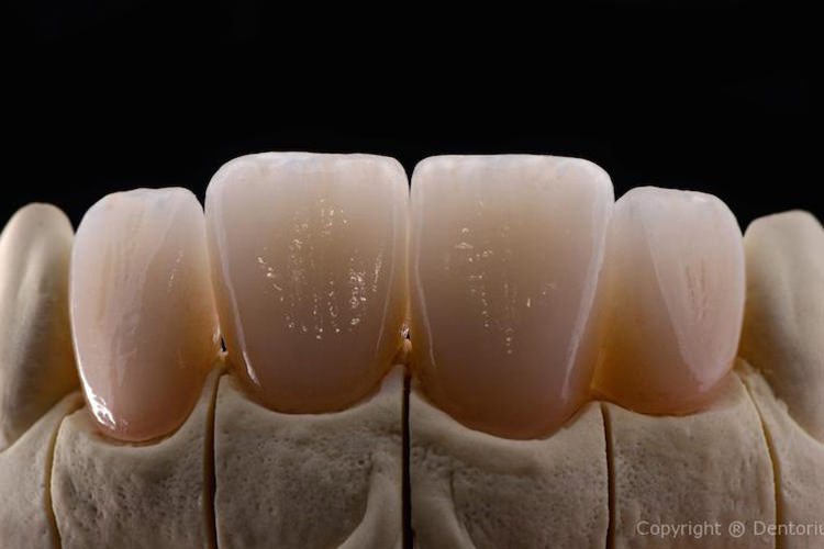ceramic crowns