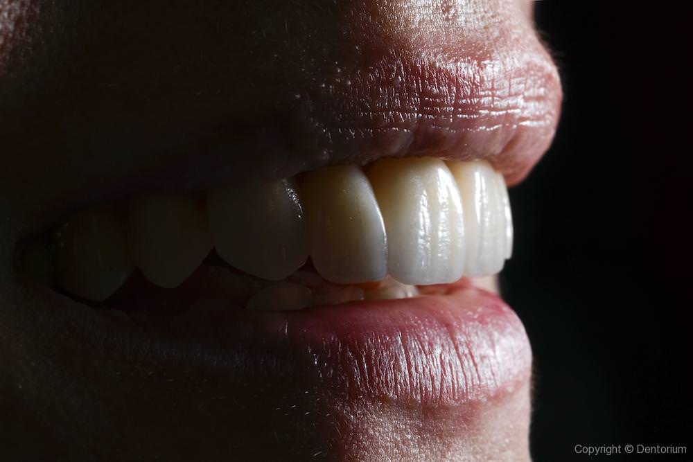 ceramic crowns - our patient Zaklina