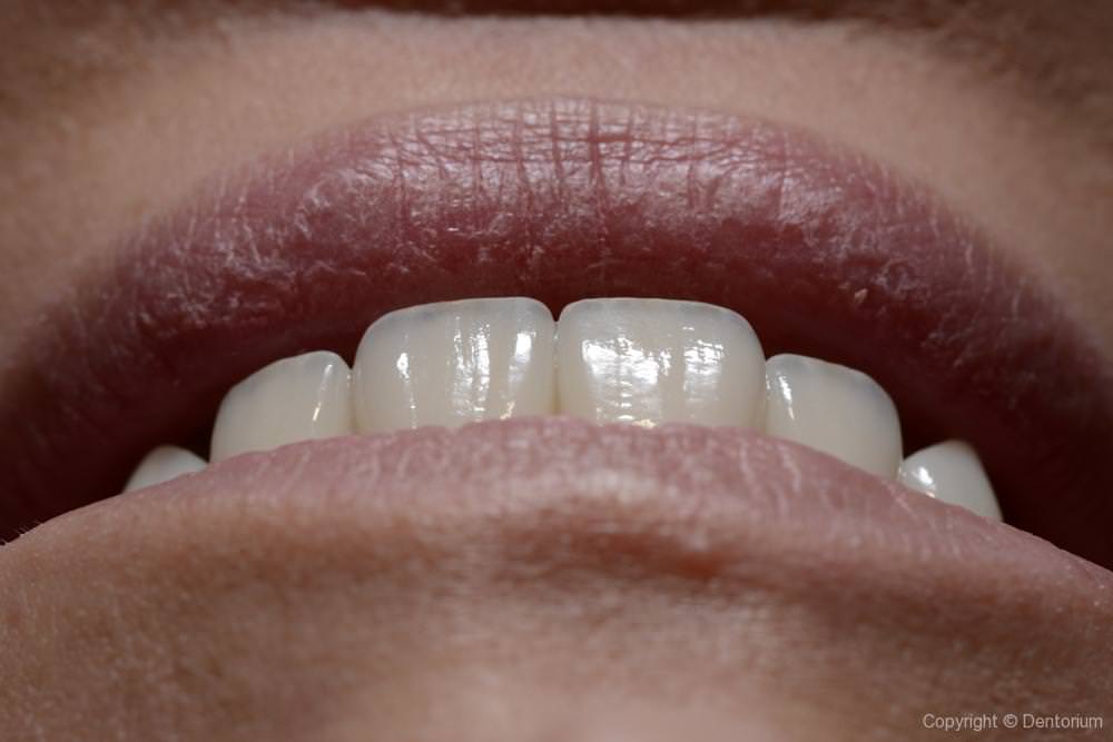ceramic veneers - our patient Ana
