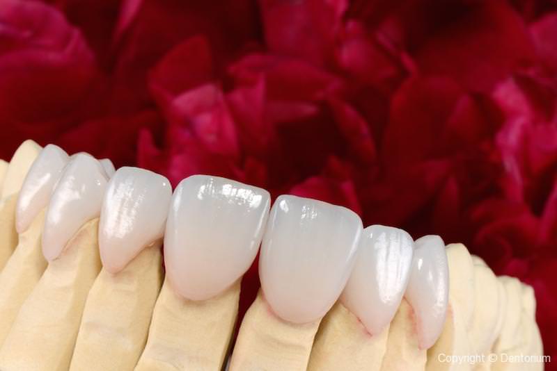 ceramic veneers - our patient Suzana