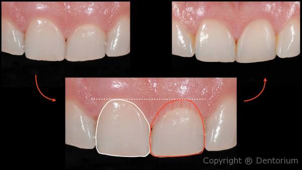 gingivoplasty