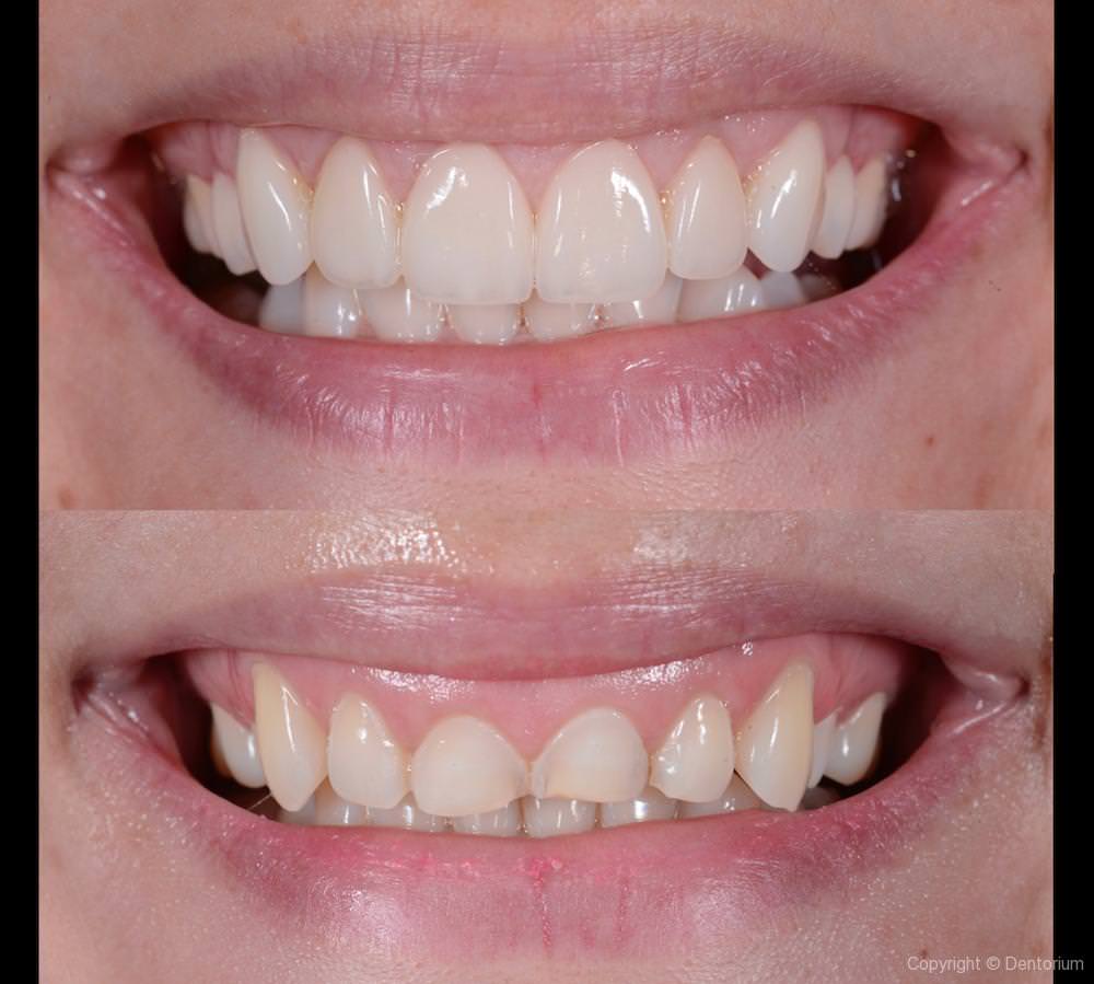 gingivoplasty - our patient milana